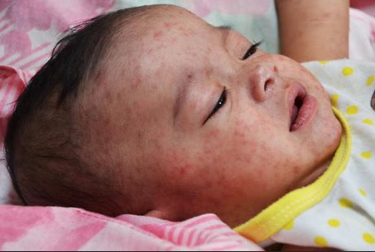 Lack Of Gov. Trust To Blame For Measles Outbreak
