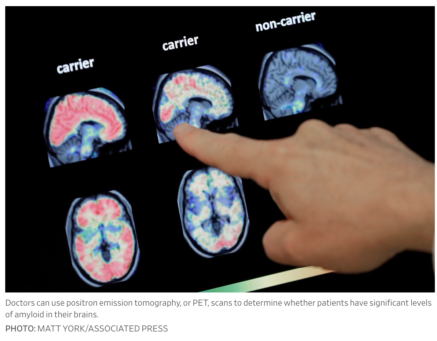 Should You Find Out If You’re At Risk of Alzheimer’s?